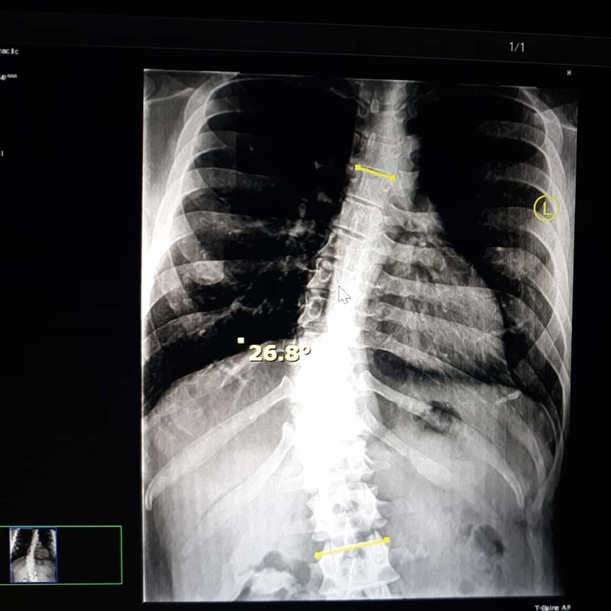 X-ray of my spine