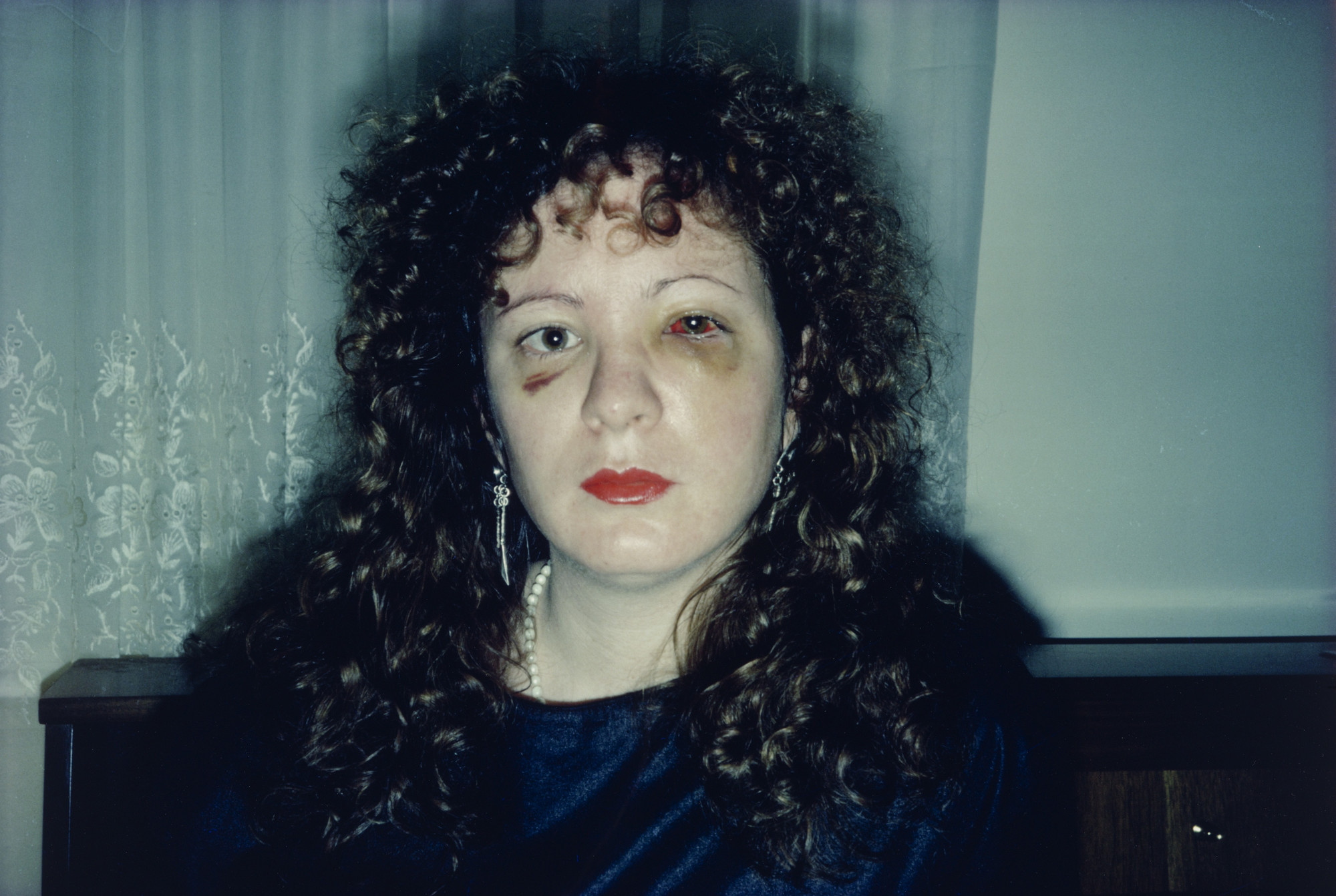 Nan Goldin. Nan One Month After Being Battered. 1984