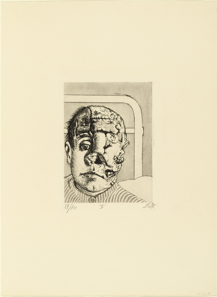 Skin Graft (Transplantation) from The War (Der Krieg), Otto Dix, (1924)