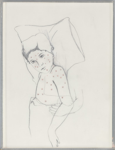 Chicken Pox
