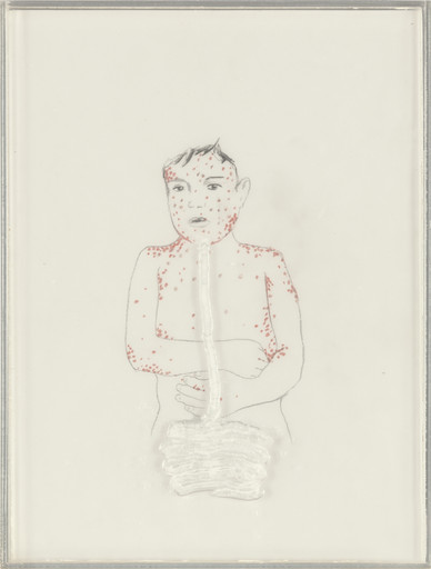 Measles with Intestines