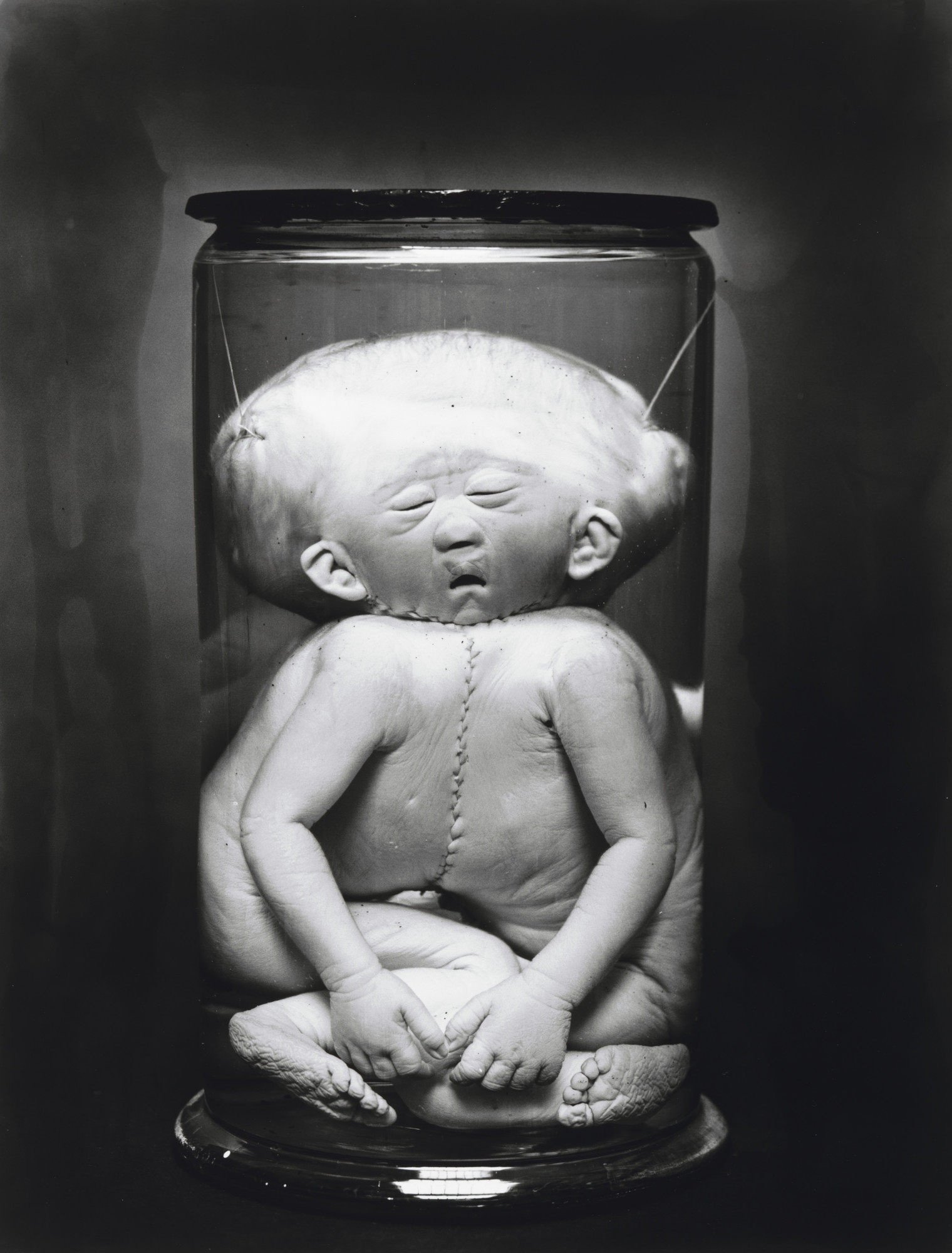 Diana Michener. Cephalo-Thoracopagus