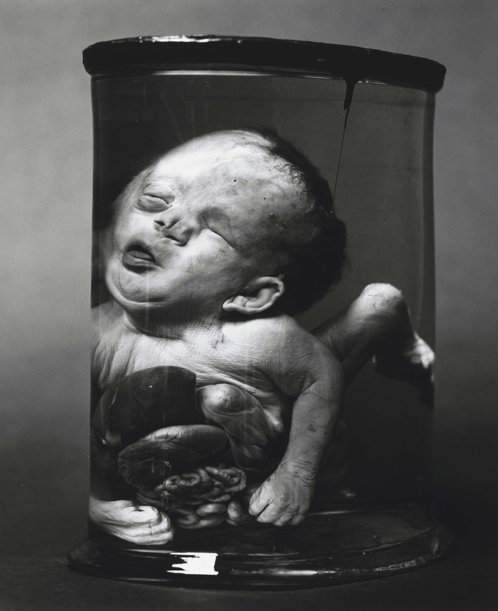 Diana Michener. Hydrocephalus, Exomphalos