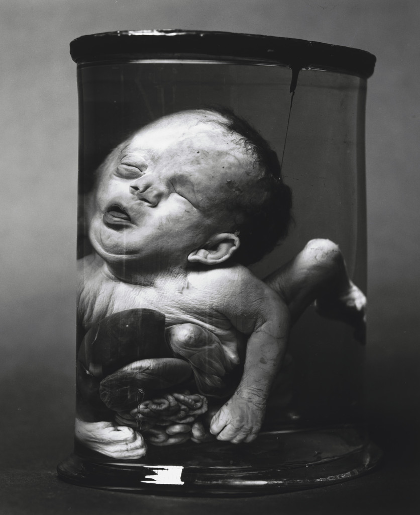 Hydrocephalus, Exomphalos