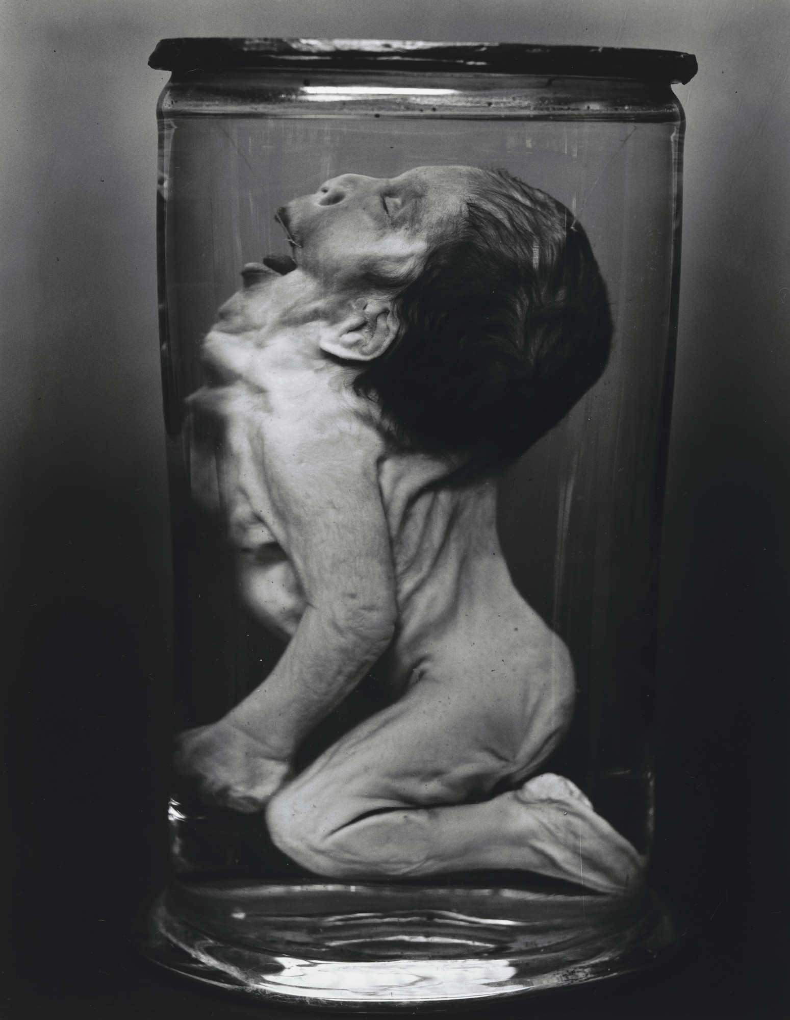 Diana Michener. Iniencephalic Foetus