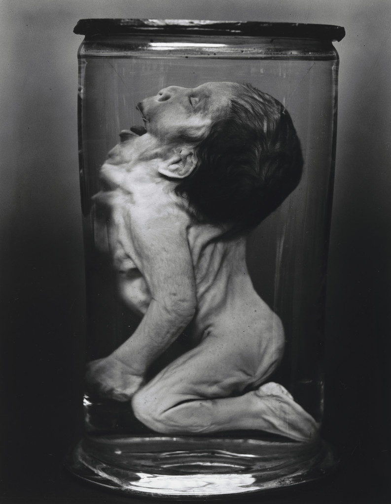 Iniencephalic Foetus