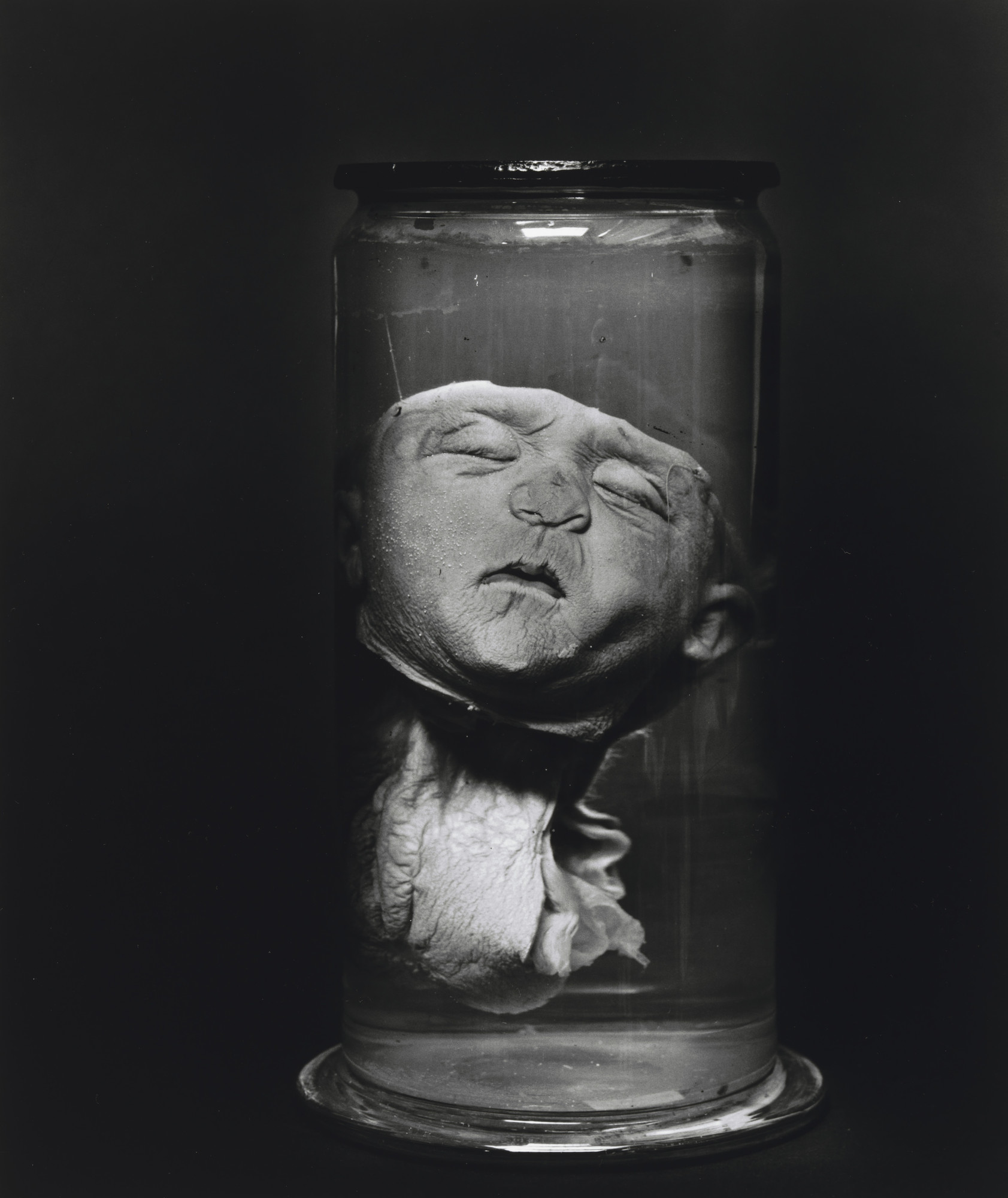 Diana Michener. Meningocoele