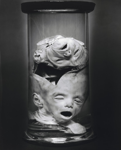 Craniopagus