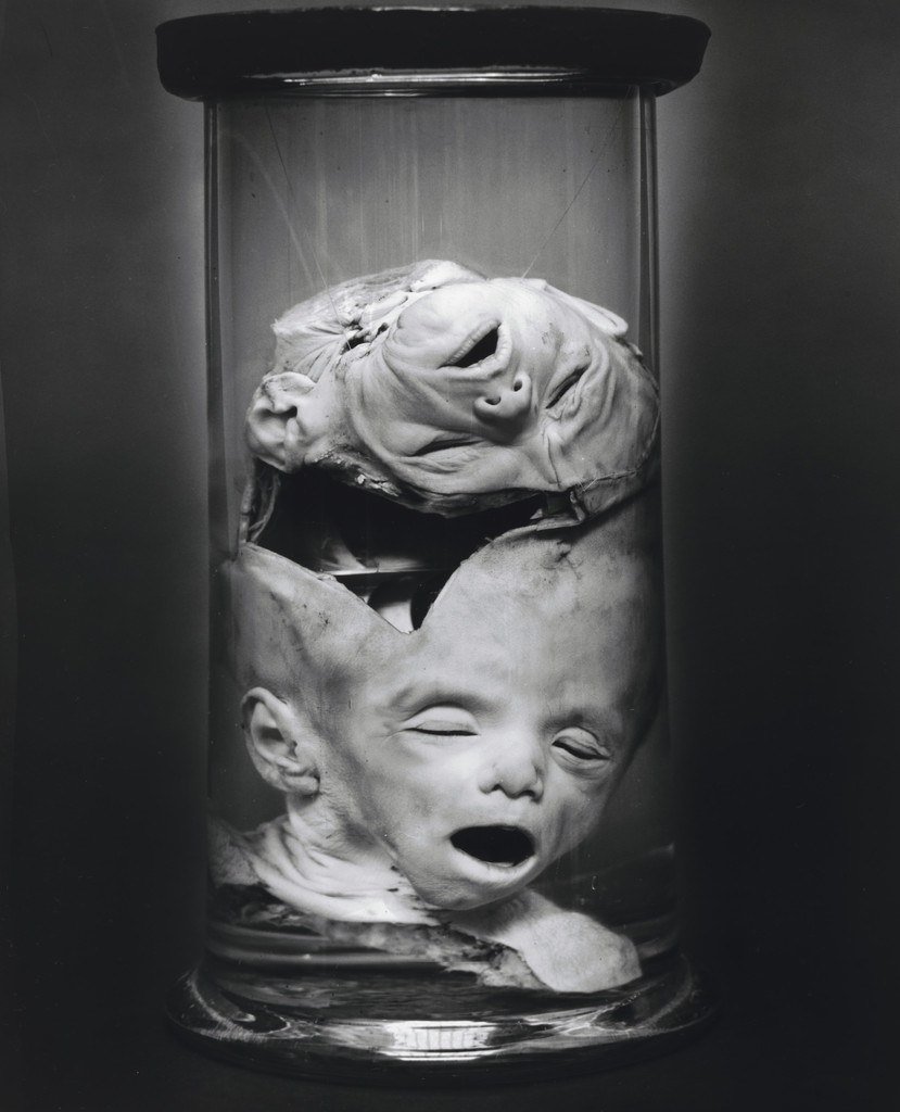 Craniopagus