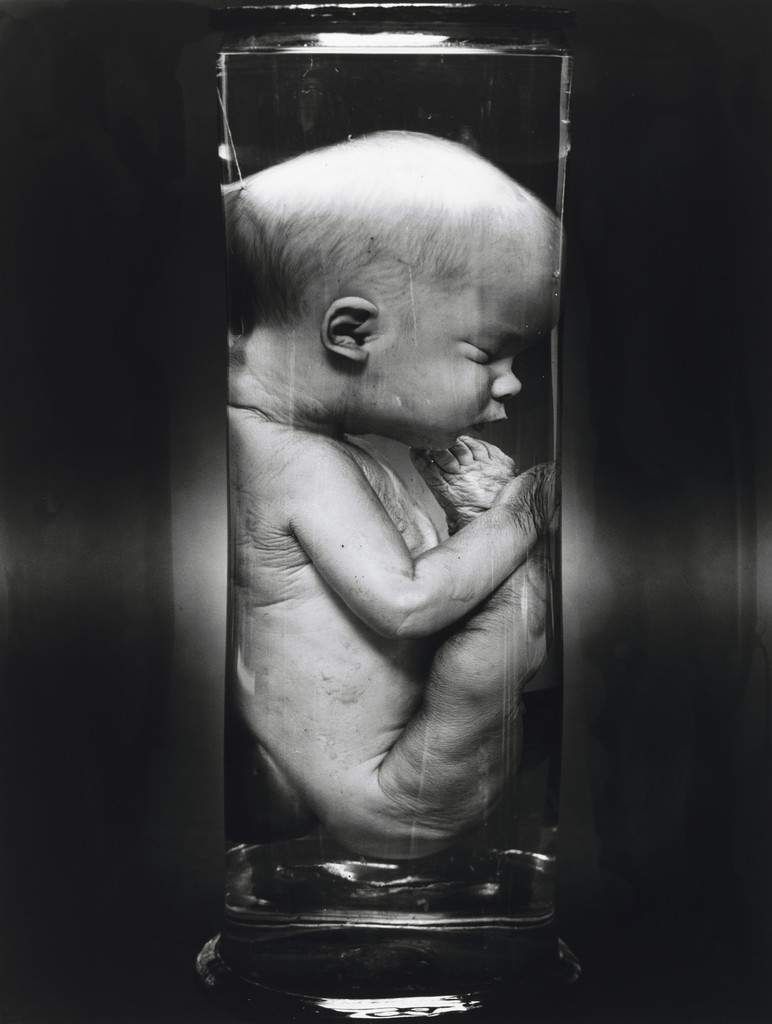 Hydrocephalus and Spina Bifida