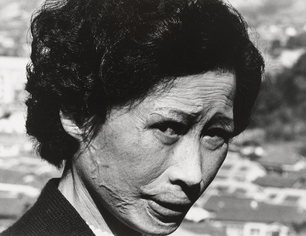 Christian with Keloidal Scars