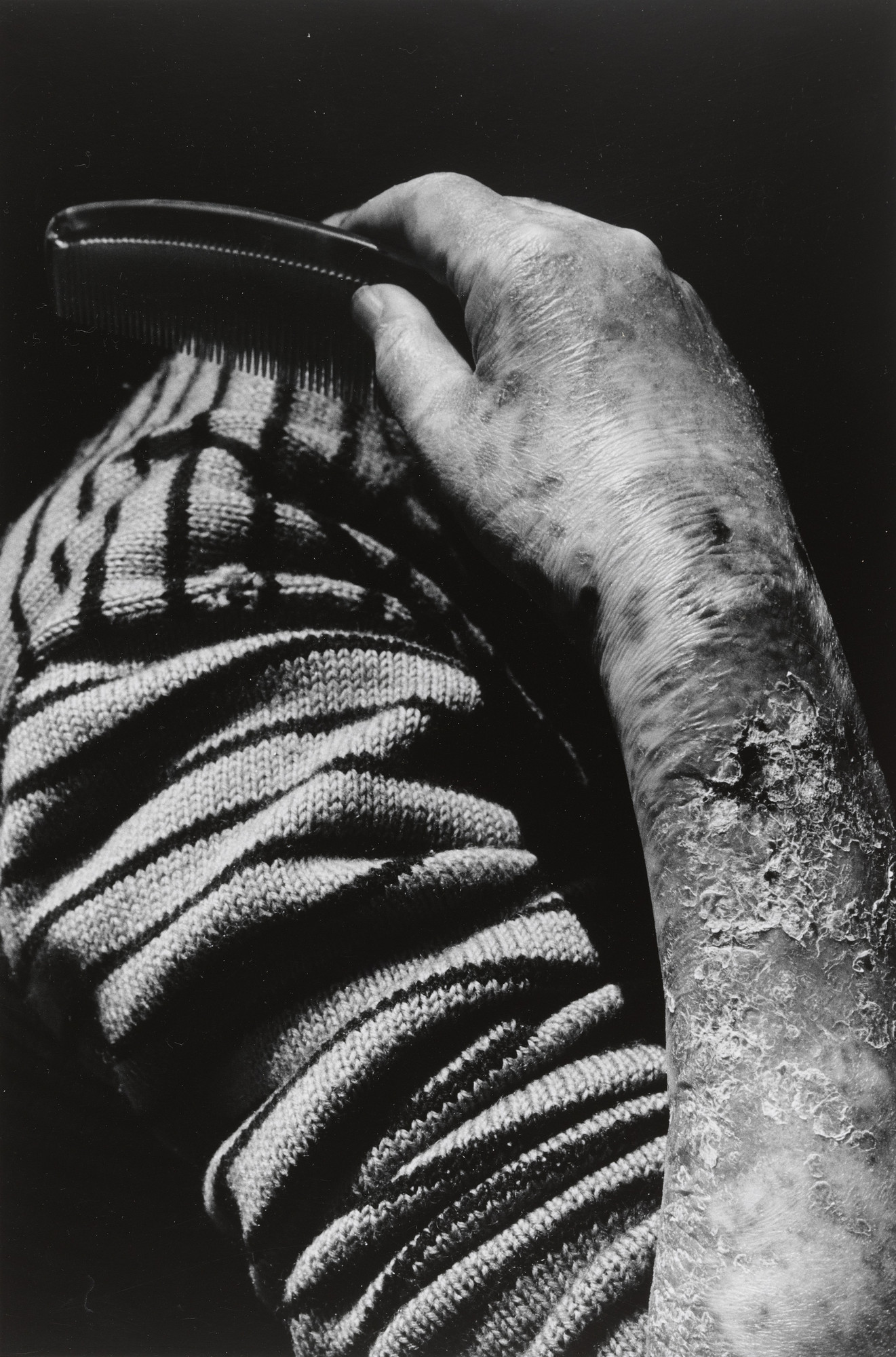 Shomei Tomatsu. Hibakusha Fukuda Sumako, Nagasaki. 1961 | MoMA