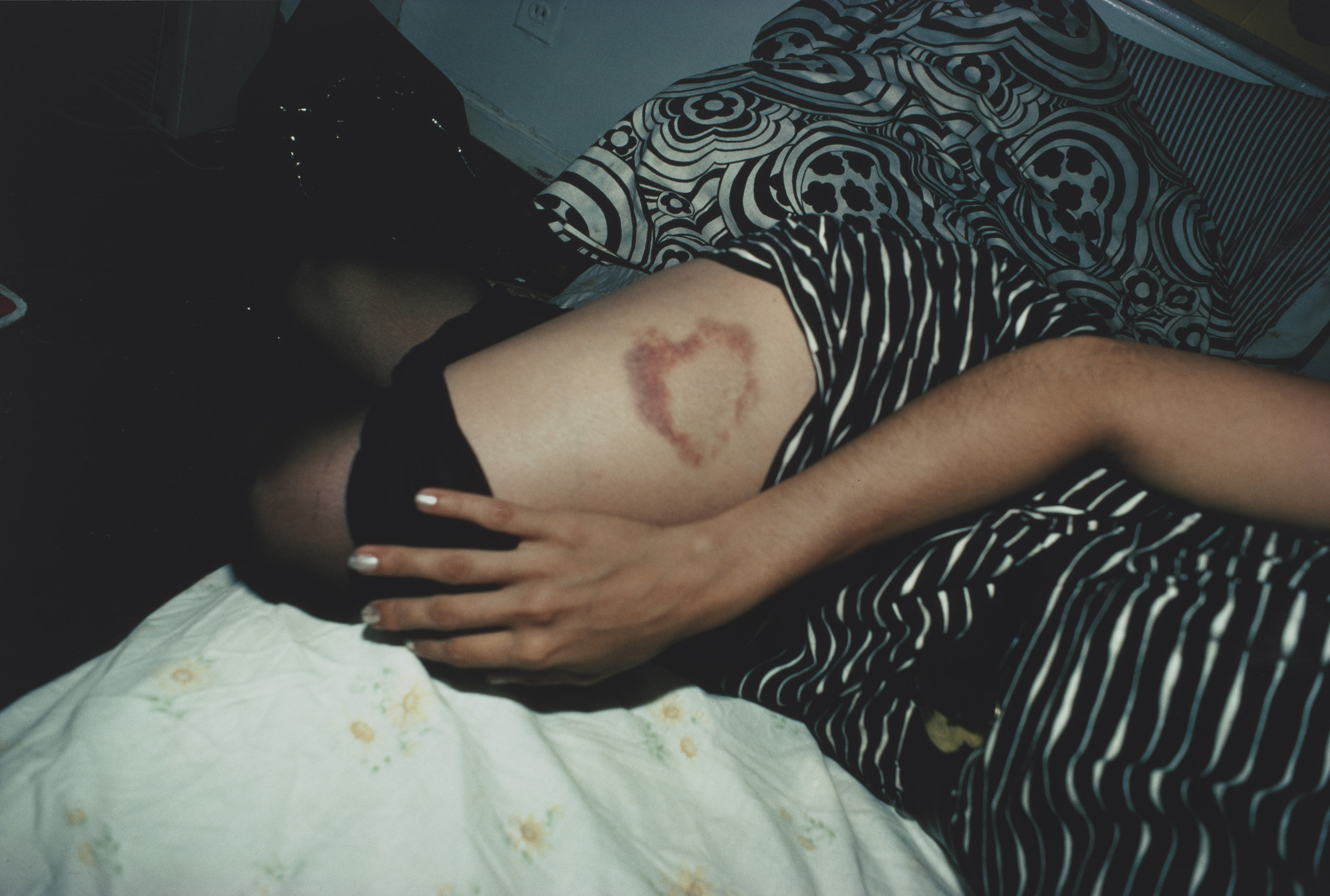 A person is lying down with their hand on their thigh, which has a reddish bruise shaped like a heart. The bedding has black and white geometric patterns and is partially visible. This is an AI generated description. To give feedback, email ai@moma.org.