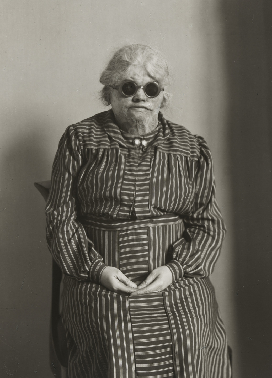 August Sander. Explosion Victim. c. 1930