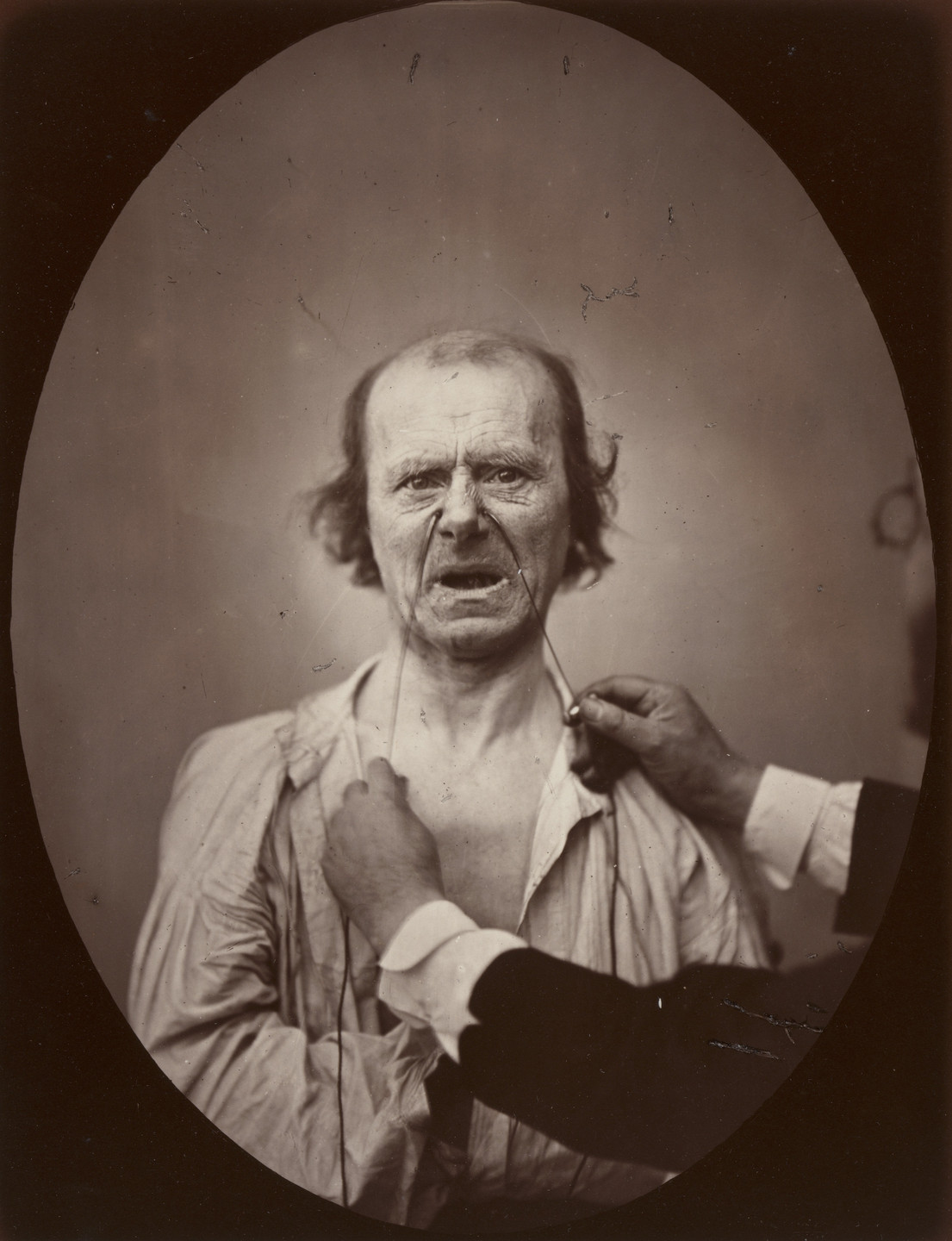 Guillaume-Benjamin-Armand Duchenne de Boulogne, Adrien Tournachon. Plate 52 from the chapter The Muscles of Weeping and Wimpering in The Mechanism of Human Facial Expression (1862). 1852–56