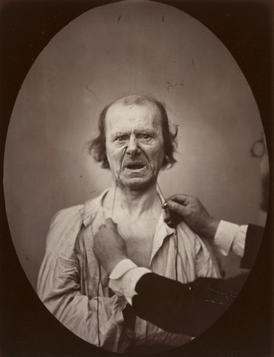 Guillaume-Benjamin-Armand Duchenne de Boulogne, Adrien Tournachon. Plate 52 from the chapter The Muscles of Weeping and Wimpering in The Mechanism of Human Facial Expression (1862). 1852–56