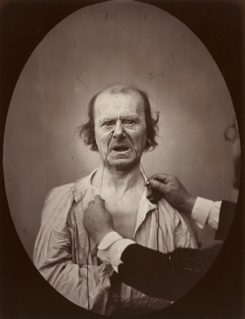 Plate 52 from the chapter The Muscles of Weeping and Wimpering in The Mechanism of Human Facial Expression (1862)