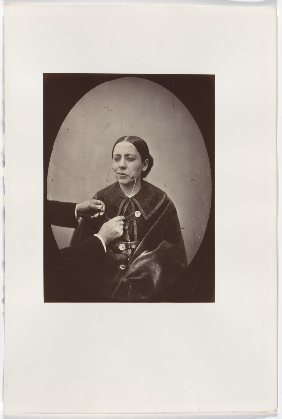 Guillaume-Benjamin-Armand Duchenne de Boulogne, Adrien Tournachon. Plate 36 from the chapter The muscles of Joy and Benevolence. c. 1856
