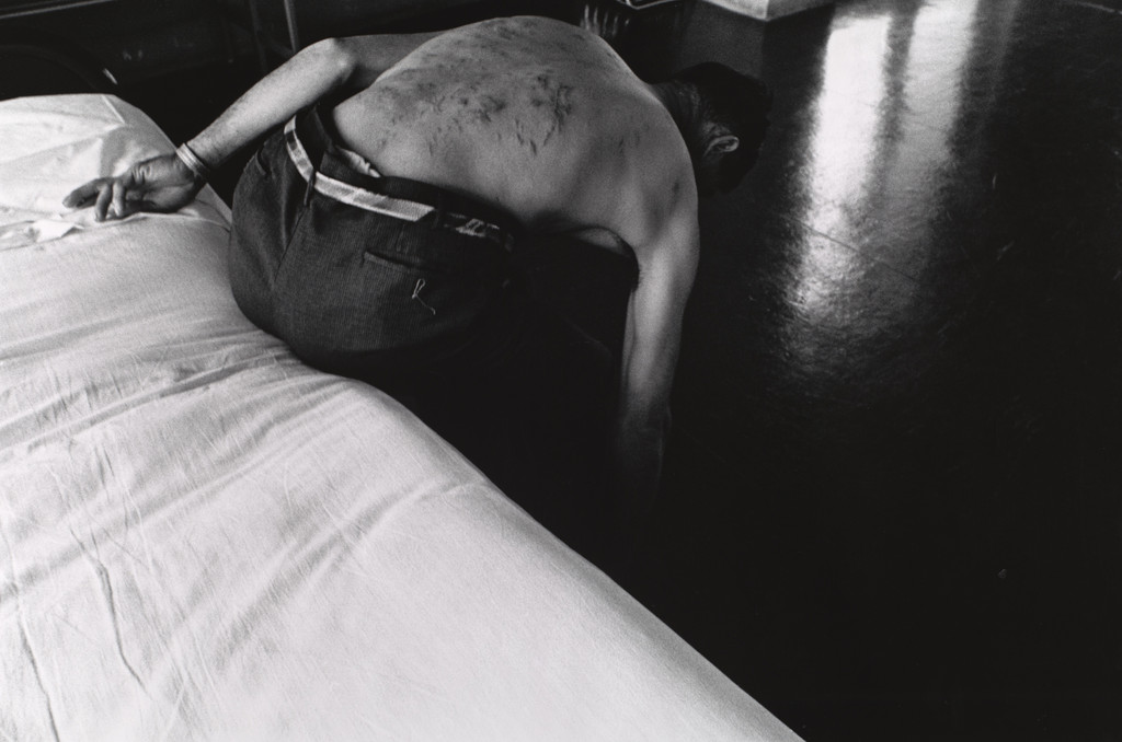 Okinawan Victim of the Atomic Bomb Explosion in Hiroshima