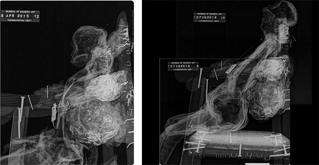 Right Figure 9A: Radiograph of CHILD before treatment. Left Figure 9B: Radiograph of CHILD after treatment. Interior armature material visible along the interior contours of the wax forms.